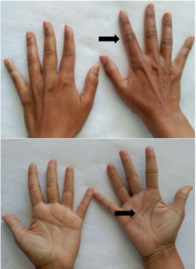 Addison's Disease Symptoms: Fatigue, Weakness, and Skin Darkening Signs
