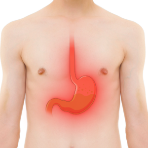 Acid Reflux Symptoms – Burning Chest Pain Explained Clearly