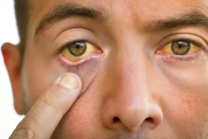 Hepatitis A Symptoms – Jaundice and Digestive Warning Signs Explained