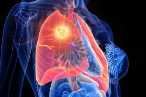 ung Cancer Symptoms – Early Signs Beyond Persistent Cough