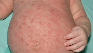 Scabies Symptoms: Night Itching, Rash, and Burrow Marks