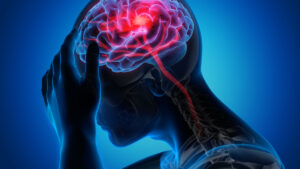 Stroke Symptoms – Act FAST Before It's Late