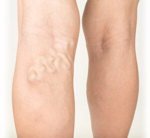 Varicose Veins Symptoms – Aching Legs And Visible Veins