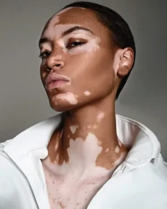 Vitiligo Symptoms: Why White Patches May Spread on Skin